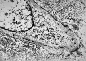 M,52y. | myofibroblastic tumor - pleura M,52y. | myofibroblastic tumor - pleura